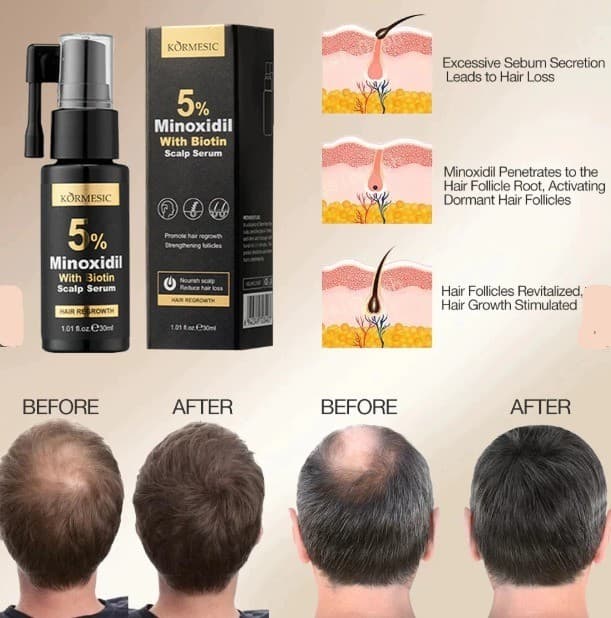 Kormesic 5% Minoxidil & Biotin Essence Water.